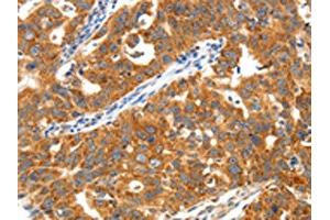 The image on the left is immunohistochemistry of paraffin-embedded Human ovarian cancer tissue using ABIN7192878(TRAF3 Antibody) at dilution 1/40, on the right is treated with synthetic peptide. (TRAF3 抗体)