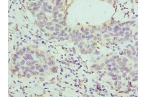 Immunohistochemistry of paraffin-embedded human bladder cancer using ABIN7155947 at dilution of 1:100 (HAPLN1 抗体  (AA 165-354))