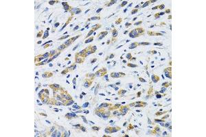 Immunohistochemistry of paraffin-embedded human gastric cancer using SLC16A4 antibody. (SLC16A4 抗体)