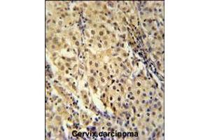 immunohistochemistry analysis in formalin fixed and paraffin embedded human cervix carcinoma followed by peroxidase conjugation of the secondary antibody and DAB staining. (FOXC2 抗体  (AA 159-186))