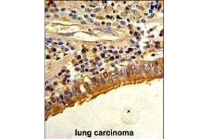 Formalin-fixed and paraffin-embedded human lung carcinoma with S Antibody (C-term), which was peroxidase-conjugated to the secondary antibody, followed by DAB staining. (Osteopontin 抗体  (C-Term))
