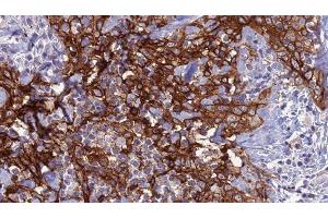 ABIN6279138 at 1/100 staining Human Head and neck cancer tissue by IHC-P. (Aquaporin 8 抗体  (N-Term))