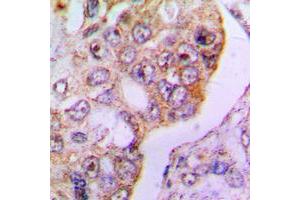 Immunohistochemical analysis of PDHA1 staining in human lung cancer formalin fixed paraffin embedded tissue section. (PDHA1 抗体  (C-Term))