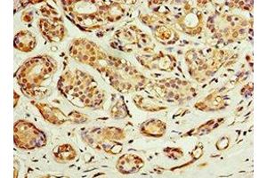 Immunohistochemistry of paraffin-embedded human breast cancer using ABIN7143229 at dilution of 1:100 (ACSM3 抗体  (AA 387-586))