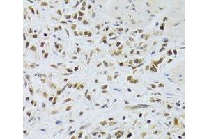 Immunohistochemistry of paraffin-embedded Human gastric cancer using RAD50 Polyclonal Antibody at dilution of 1:100 (40x lens). (RAD50 抗体)