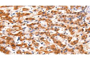 Immunohistochemistry of paraffin-embedded Human liver cancer tissue using FBLN1 Polyclonal Antibody at dilution 1:47 (Fibulin 1 抗体)