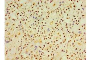 Immunohistochemistry of paraffin-embedded human breast cancer using ABIN7149845 at dilution of 1:100 (DGKE 抗体  (AA 40-260))