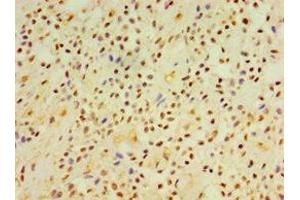 Immunohistochemistry of paraffin-embedded human breast cancer using ABIN7149845 at dilution of 1:100 (DGKE 抗体  (AA 40-260))