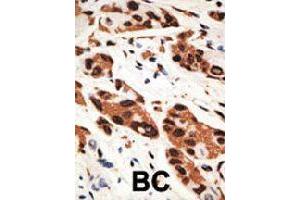Formalin-fixed and paraffin-embedded human cancer tissue reacted with GJB5 polyclonal antibody  , which was peroxidase-conjugated to the secondary antibody, followed by AEC staining. (GJB5 抗体  (Internal Region))