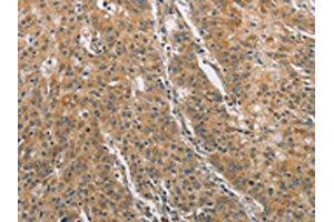 The image on the left is immunohistochemistry of paraffin-embedded Human gastric cancer tissue using ABIN7129185(DDX53 Antibody) at dilution 1/75, on the right is treated with fusion protein. (DDX53 抗体)