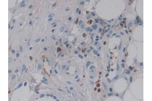IHC-P analysis of Human Skin cancer Tissue, with DAB staining. (CSF2RA 抗体  (AA 28-112))