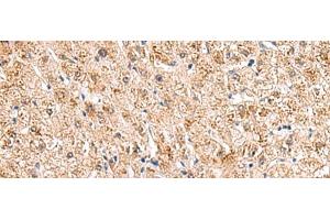 Immunohistochemistry of paraffin-embedded Human liver cancer tissue using HCCS Polyclonal Antibody at dilution of 1:110(x200) (HCCS 抗体)