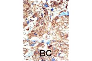 Formalin-fixed and paraffin-embedded human cancer tissue reacted with the primary antibody, which was peroxidase-conjugated to the secondary antibody, followed by DAB staining. (EPH Receptor B1 抗体  (C-Term))