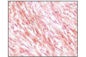 Immunohistochemical analysis of paraffin-embedded maligant mesenchymoma tissues, showing cytoplasmic localization using C-kit mouse mAb with DAB staining. (KIT 抗体)