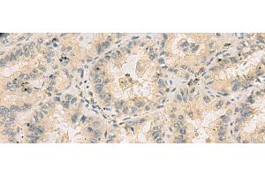 Immunohistochemistry of paraffin-embedded Human lung cancer tissue using HHIPL2 Polyclonal Antibody at dilution of 1:55(x200) (HHIPL2 抗体)