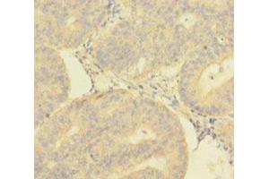 Immunohistochemistry of paraffin-embedded human endometrial cancer using ABIN7149718 at dilution of 1:100 (DNTTIP1 抗体  (AA 1-329))
