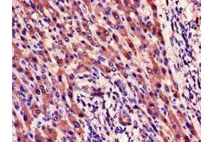 Immunohistochemistry of paraffin-embedded human liver cancer using ABIN7165238 at dilution of 1:100 (CYR61 抗体  (AA 25-381))