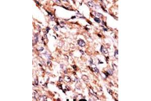 Formalin-fixed and paraffin-embedded human cancer tissue reacted with the primary antibody, which was peroxidase-conjugated to the secondary antibody, followed by AEC staining. (BCKDK 抗体  (AA 120-151))