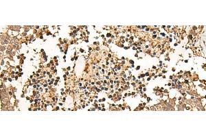 Immunohistochemistry of paraffin-embedded Human lung cancer tissue using LDHA Polyclonal Antibody at dilution of 1:25(x200) (Lactate Dehydrogenase A 抗体)