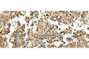 Immunohistochemistry of paraffin-embedded Human lung cancer tissue using LDHA Polyclonal Antibody at dilution of 1:25(x200)