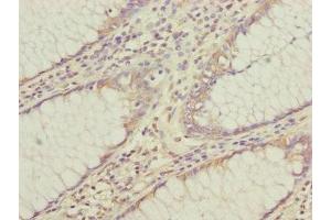 Immunohistochemistry of paraffin-embedded human colon cancer using ABIN7147439 at dilution of 1:100 (CEP95 抗体  (AA 582-821))