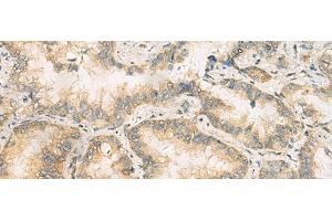 Immunohistochemistry of paraffin-embedded Human lung cancer tissue using RAB13 Polyclonal Antibody at dilution of 1:50(x200) (RAB13 抗体)