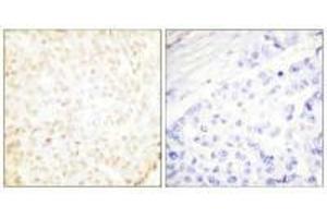 Immunohistochemistry analysis of paraffin-embedded human breast carcinoma tissue using XRCC5 antibody. (XRCC5 抗体  (C-Term))