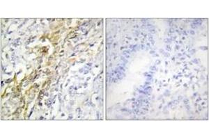 Immunohistochemistry analysis of paraffin-embedded human lung carcinoma tissue, using CKI-alpha Antibody. (CSNK1A1 抗体  (AA 126-175))