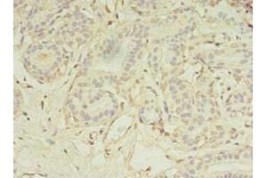 Immunohistochemistry of paraffin-embedded human breast cancer using ABIN7159399 at dilution of 1:100 (MS4A7 抗体  (AA 1-47))
