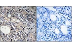 Immunohistochemistry analysis of paraffin-embedded human prostate carcinoma tissue, using RPL17 Antibody. (RPL17 抗体  (AA 101-150))