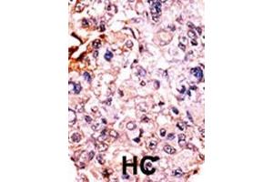 Formalin-fixed and paraffin-embedded human cancer tissue reacted with the primary antibody, which was peroxidase-conjugated to the secondary antibody, followed by AEC staining. (CDKN1B 抗体  (pThr187))