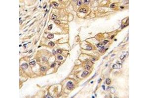 IHC analysis of FFPE human lung carcinoma tissue stained with EPHB2 antibody (EPH Receptor B2 抗体)