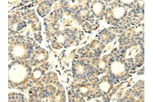 The image on the left is immunohistochemistry of paraffin-embedded Human thyroid cancer tissue using ABIN7193043(WDR91 Antibody) at dilution 1/20, on the right is treated with synthetic peptide. (WDR91 抗体)