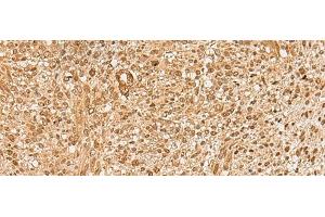 Immunohistochemistry of paraffin-embedded Human liver cancer tissue using HIRIP3 Polyclonal Antibody at dilution of 1:60(x200) (HIRIP3 抗体)