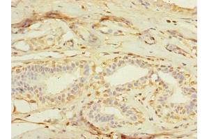 Immunohistochemistry of paraffin-embedded human breast cancer using ABIN7159074 at dilution of 1:100 (MXD3 抗体  (AA 1-206))