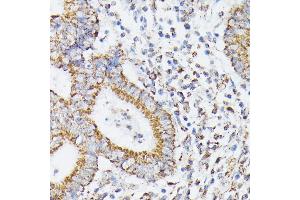 Immunohistochemistry of paraffin-embedded human colon carcinoma using RHOG antibody (ABIN7269864) at dilution of 1:100 (40x lens). (RHOG 抗体)