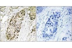 Immunohistochemistry analysis of paraffin-embedded human lung carcinoma tissue, using GA45G Antibody. (GADD45G 抗体  (AA 101-150))