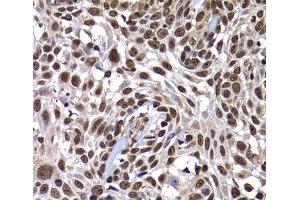 Immunohistochemistry of paraffin-embedded Human well-differentiated squamous skin carcinoma using DNAJB6 Polyclonal Antibody at dilution of 1:100 (40x lens). (DNAJB6 抗体)