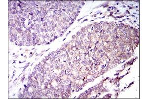 Immunohistochemical analysis of paraffin-embedded esophageal cancer tissues using GUCY1A3 mouse mAb with DAB staining. (GUCY1A1 抗体  (AA 22-214))