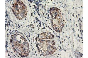 Immunohistochemical staining of paraffin-embedded Adenocarcinoma of Human breast tissue using anti-DAND5 mouse monoclonal antibody. (DAND5 抗体  (AA 23-189))