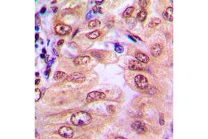 Immunohistochemical analysis of SMAD1/9 (pS465/467) staining in human breast cancer formalin fixed paraffin embedded tissue section. (Smad1/9 抗体  (C-Term, pSer465, pSer467))