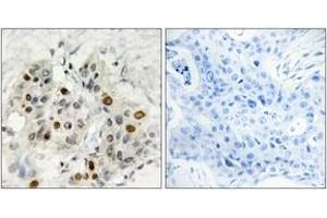 Immunohistochemistry analysis of paraffin-embedded human breast carcinoma tissue, using AF4 Antibody. (AF4 抗体  (AA 1-50))