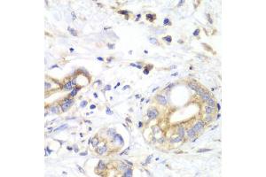 Immunohistochemistry of paraffin-embedded human liver cancer using TXN2 antibody (ABIN6291019) at dilution of 1:100 (40x lens). (TXN2 抗体)