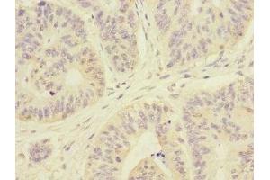 Immunohistochemistry of paraffin-embedded human colon cancer using ABIN7167980 at dilution of 1:100 (ARHGEF3 抗体  (AA 287-526))