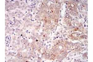 Immunohistochemical analysis of paraffin-embedded human cervical cancer tissues using BLNK mouse mAb with DAB staining. (B-Cell Linker 抗体)