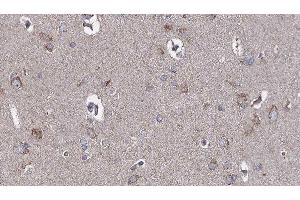 ABIN6276680 at 1/100 staining Human brain cancer tissue by IHC-P. (TLR3 抗体  (C-Term))