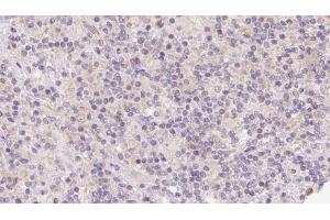 ABIN6273124 at 1/100 staining Human lymph cancer tissue by IHC-P. (HOMER1 抗体  (Internal Region))