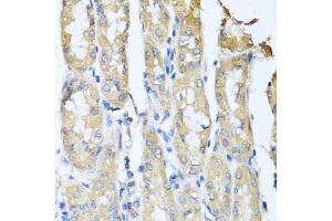 Immunohistochemistry of paraffin-embedded human gastric cancer using CCL3 antibody (ABIN5974742) at dilution of 1/100 (40x lens). (CCL3 抗体)