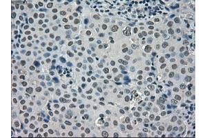 Immunohistochemical staining of paraffin-embedded Adenocarcinoma of ovary tissue using anti-SATB1mouse monoclonal antibody. (SATB1 抗体)