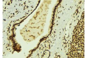 ABIN6269400 at 1/100 staining Human breast cancer tissue by IHC-P. (HDAC6 抗体  (N-Term))